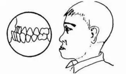 北京京都儿童医院专家讲解：儿童牙齿矫正的3个黄金期