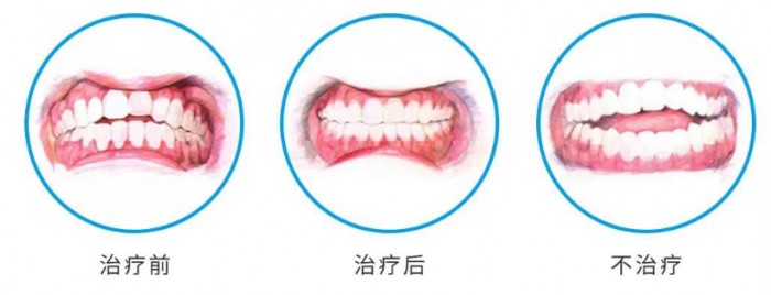 北京京都儿童医院专家讲解：儿童牙齿矫正的3个黄金期