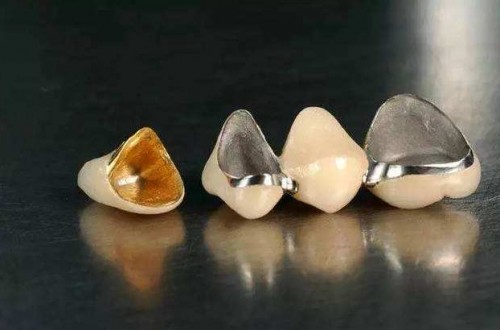 杭州种植牙技术——史上最详细的种植牙,了解一下?