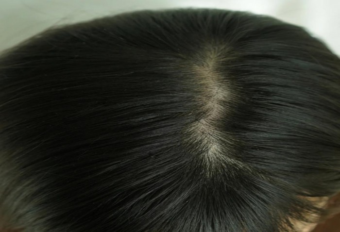 经常一洗完头发就出油，头皮油脂分泌旺盛怎么办？