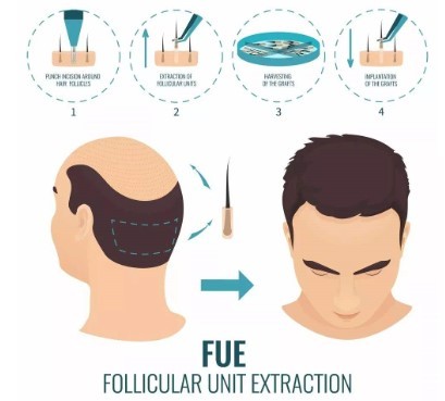 治疗脱发更有效的方法是什么？北京熙朵SFUE植发技术成热门