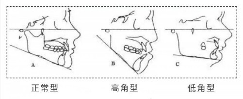 根据下颌角的高度一般可以分为:正常型,高角型和低角型,低角型的人