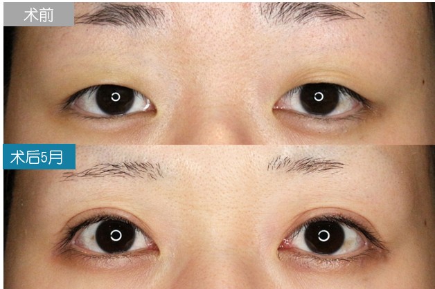 圣心美容丁奕如医生解析：想要get自然的日式双眼皮,需要注意哪几点？