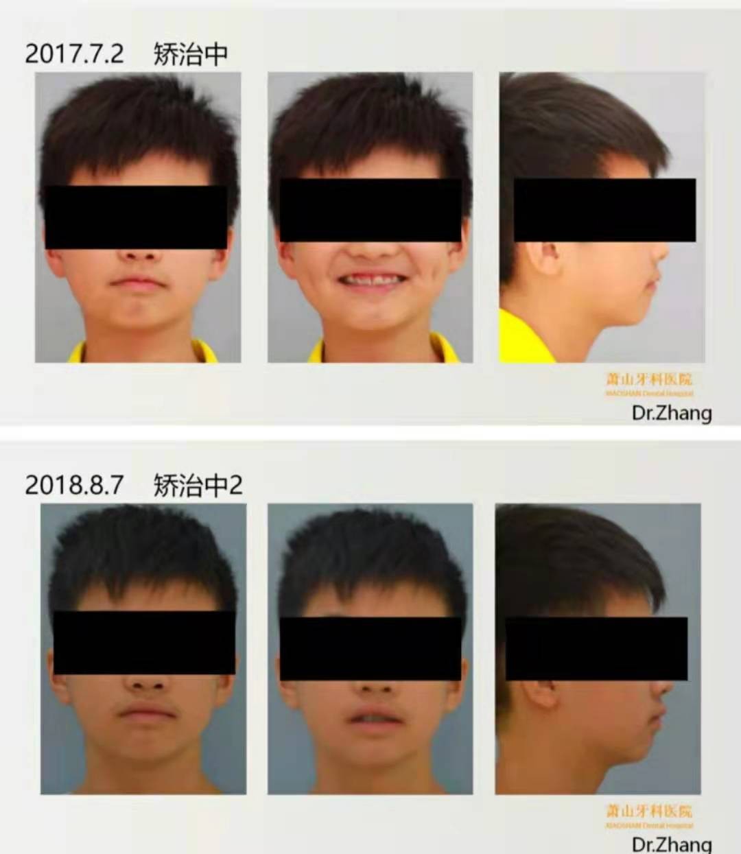 杭州牙科医院——儿童牙齿矫正案例拆解
