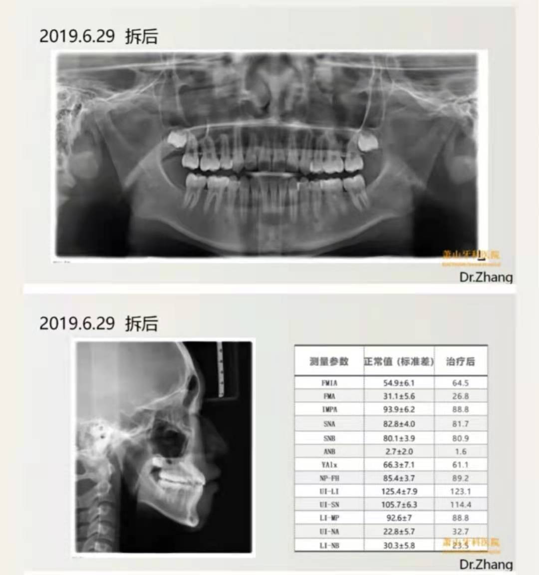 杭州牙科医院——儿童牙齿矫正案例拆解