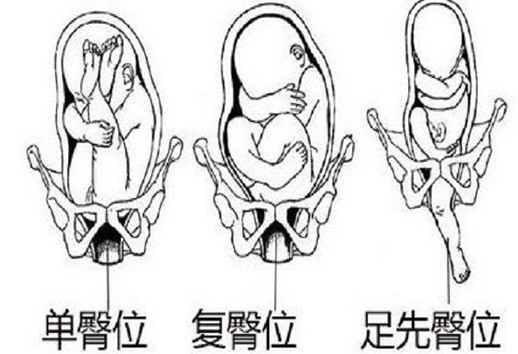 十个臀位九个女孩真的吗,胎儿臀位是什么原因