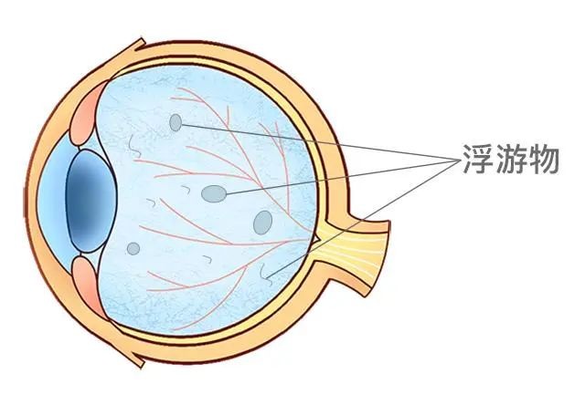 合肥爱尔眼科：飞蚊症”可致盲？中老年人必知真相来了！