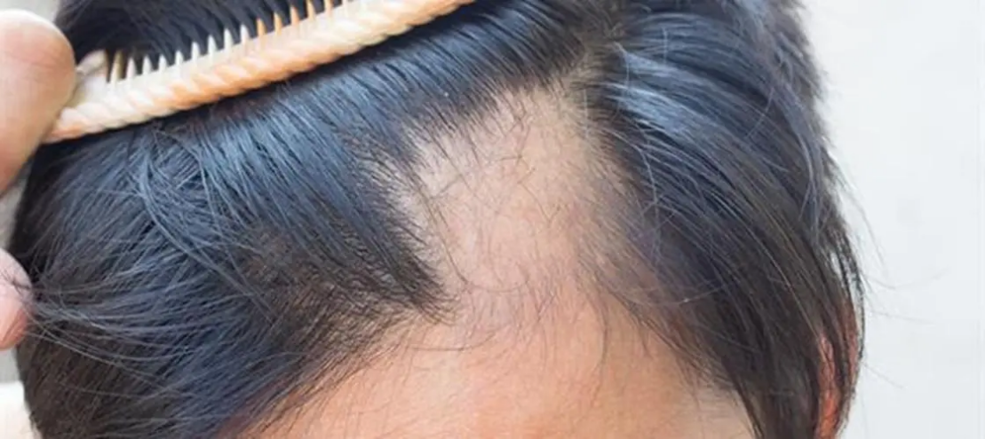 女性脱发也能有春天 2%米诺地尔守护你的发量
