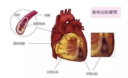 致死率高于癌症，关于心肌梗死你了解多少？