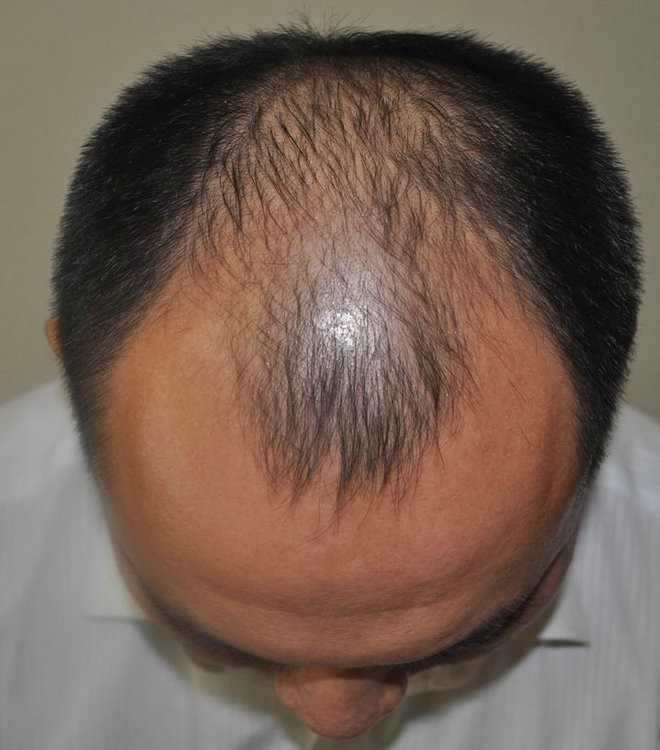 脂溢性脱发的症状病发原因和类型