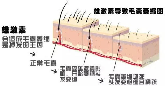 西安熙朵李会民植发预防脱发的正确方式治脱发选对方法是关键