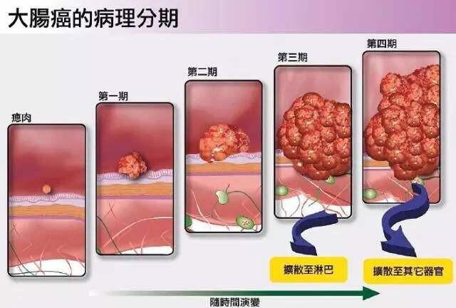 平頂山東大肛腸醫院帶您揭秘:過量食肉=便秘 腸息肉?